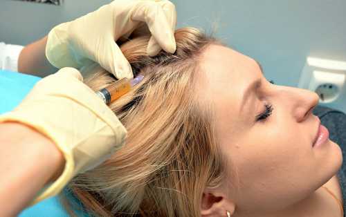 Плазмолифтинг для волос плазмотерапия волосистой части головы