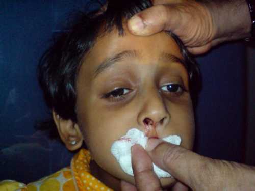 Кровь из носа у ребенка